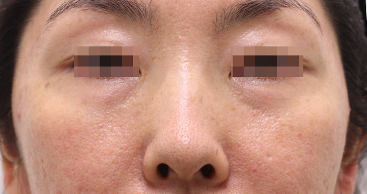 目の下のクマの症例写真（Before）／40代 女性