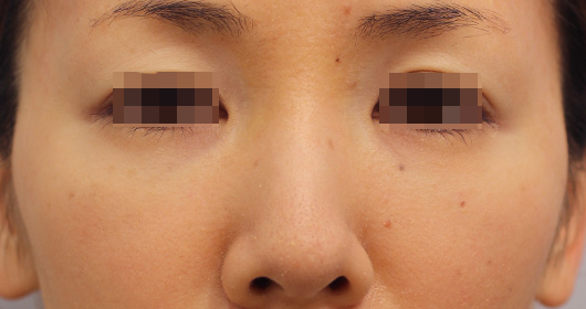 目の下のクマの症例写真（After）／30代 女性