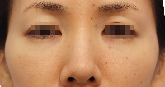 目の下のクマの症例写真（Before）／30代 女性