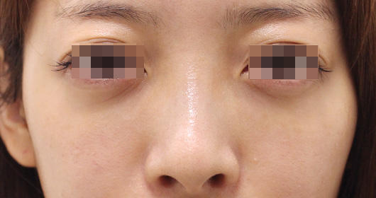 目の下のクマの症例写真（Before）／20代 女性