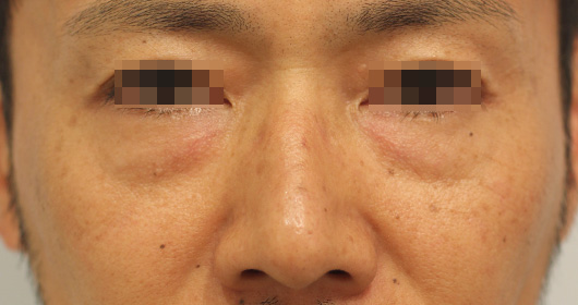 目の下のクマの症例写真（After）／40代 男性