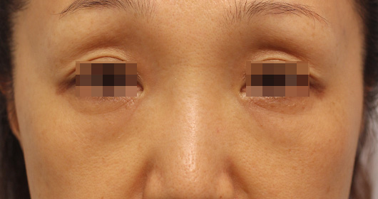 目の下のクマの症例写真（Before）／50代 女性