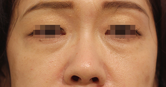 目の下のクマの症例写真（After）／40代 女性