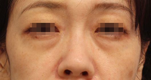 目の下のクマの症例写真（Before）／40代 女性