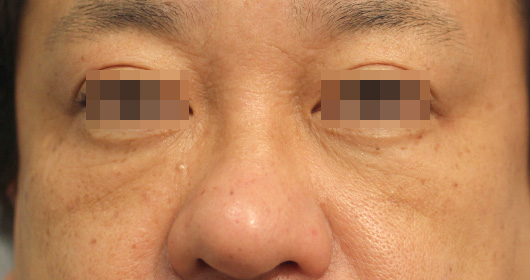 目の下のクマ,ゴルゴ線の症例写真（After）／40代 男性