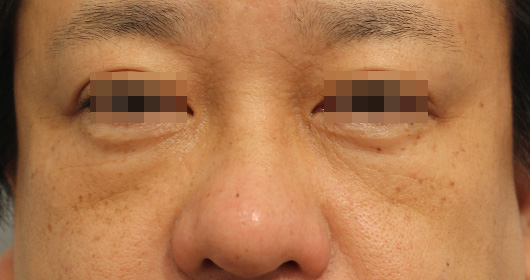 目の下のクマ,ゴルゴ線の症例写真（Before）／40代 男性