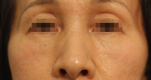 目の下のクマの症例写真（After）／50代 女性