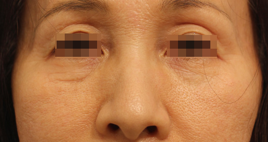 目の下のクマの症例写真（Before）／50代 女性