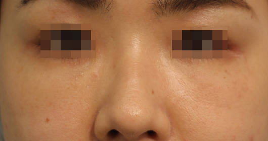 目の下のクマの症例写真（After）／30代 女性
