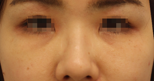 目の下のクマの症例写真（Before）／30代 女性
