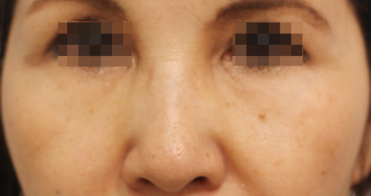 目の下のクマの症例写真（After）／50代 女性