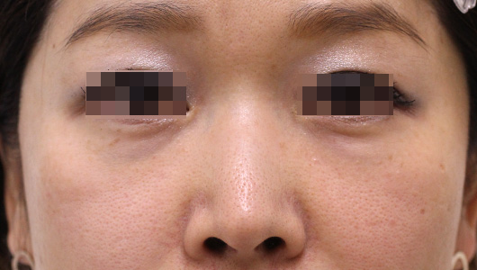 目の下のクマの症例写真（After）／40代 女性