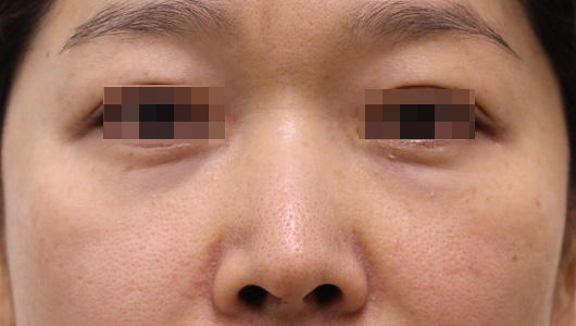 目の下のクマの症例写真（Before）／40代 女性