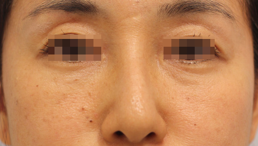 目の下のクマの症例写真（After）／40代 女性