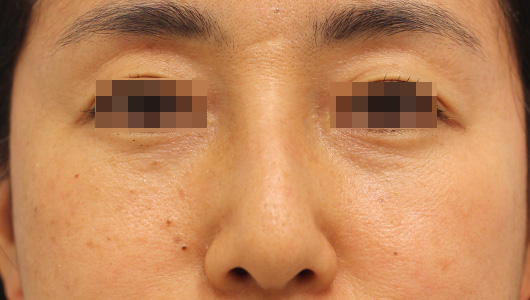 目の下のクマの症例写真（Before）／40代 女性