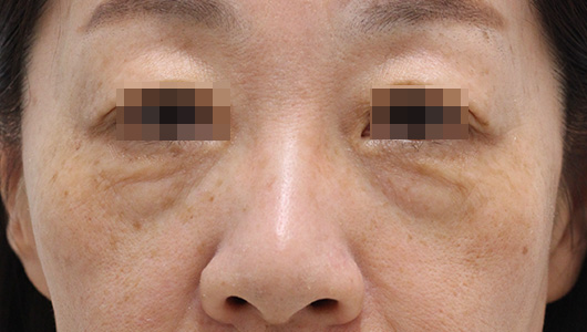 目の下のクマの症例写真（Before）／50代 女性