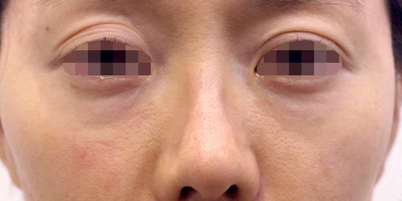 目の下のクマの症例写真（After）／40代 女性