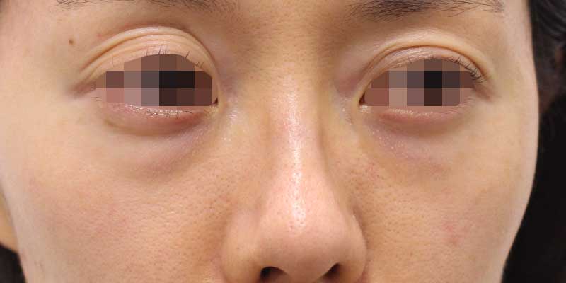 目の下のクマの症例写真（Before）／40代 女性