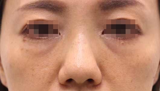 目の下のクマの症例写真（Before）／40代 女性