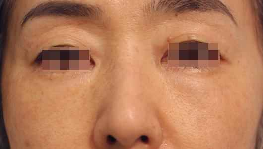 目の下のクマの症例写真（After）／40代 女性