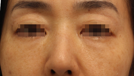 目の下のクマの症例写真（Before）／40代 女性