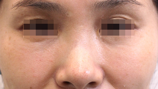目の下のクマの症例写真（After）／50代 女性