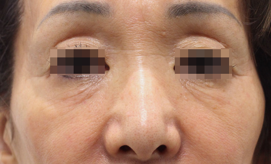 目の下のクマ,ゴルゴ線の症例写真（After）／60代 女性