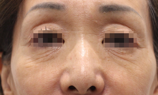 目の下のクマ,ゴルゴ線の症例写真（Before）／60代 女性
