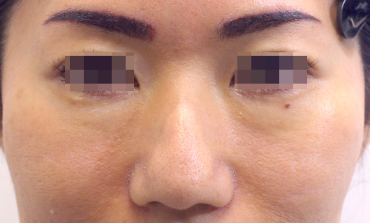 目の下のクマの症例写真（After）／40代 女性