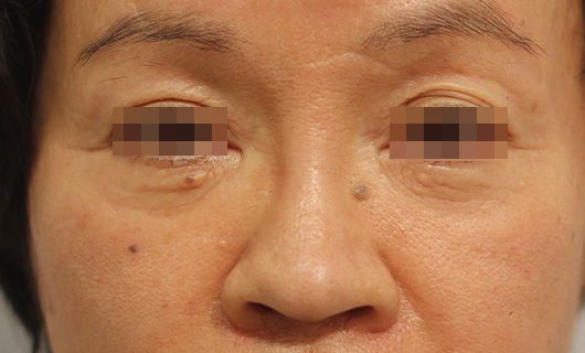目の下のクマの症例写真（After）／60代 女性