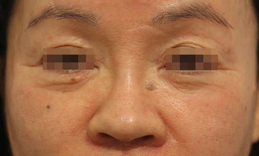 目の下のクマの症例写真（Before）／60代 女性