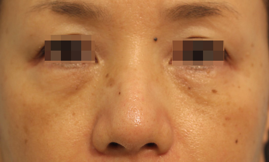 目の下のクマの症例写真（After）／60代 女性