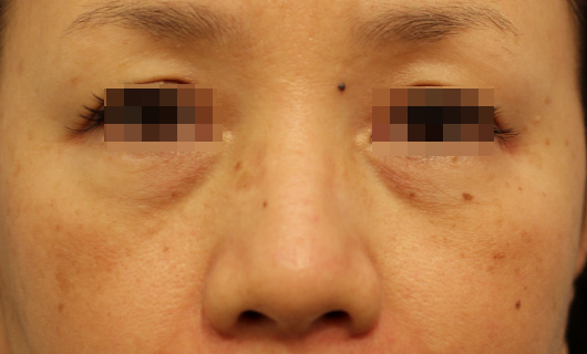 目の下のクマの症例写真（Before）／60代 女性