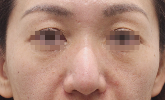 目の下のクマの症例写真（After）／40代 女性