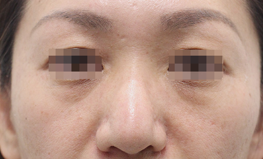 目の下のクマの症例写真（Before）／40代 女性