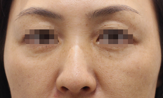 目の下のクマの症例写真（Before）／40代 女性