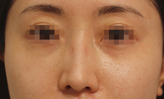 目の下のクマの症例写真（After）／30代 女性