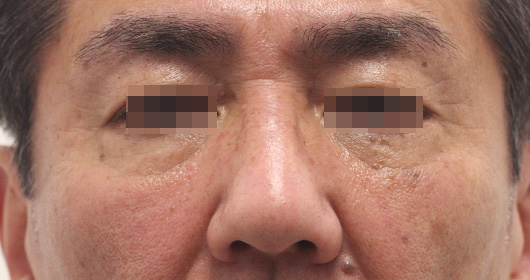 目の下のクマの症例写真（After）／60代 男性