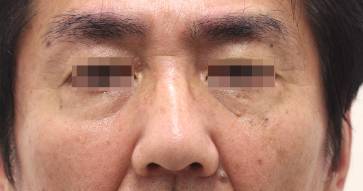 目の下のクマの症例写真（Before）／60代 男性