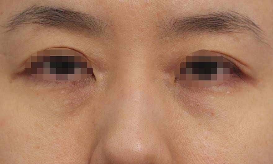 目の下のクマの症例写真（After）／40代 女性