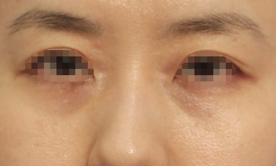 目の下のクマの症例写真（Before）／40代 女性