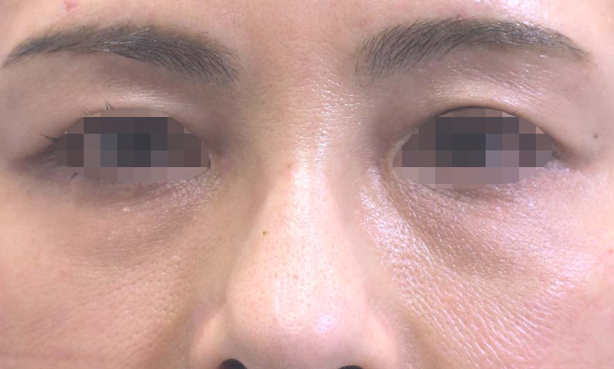 目の下のクマの症例写真（After）／50代 女性