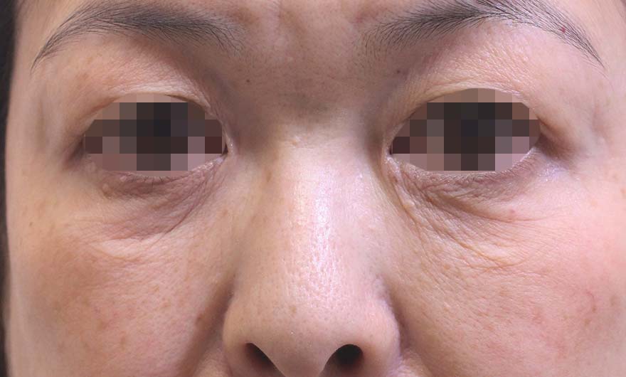 目の下のクマの症例写真（After）／50代 女性