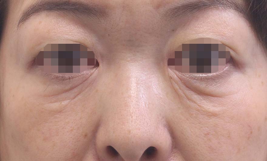 目の下のクマの症例写真（Before）／50代 女性