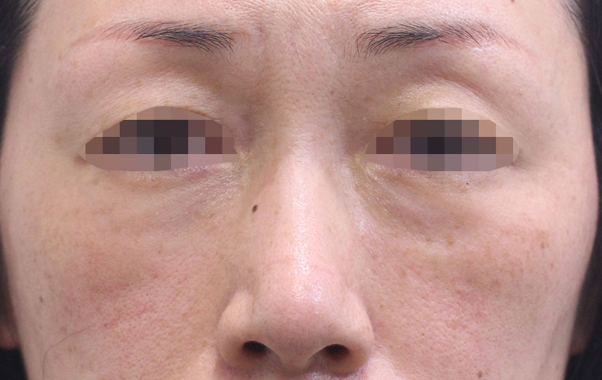 目の下のクマ,ゴルゴ線の症例写真（After）／50代 女性
