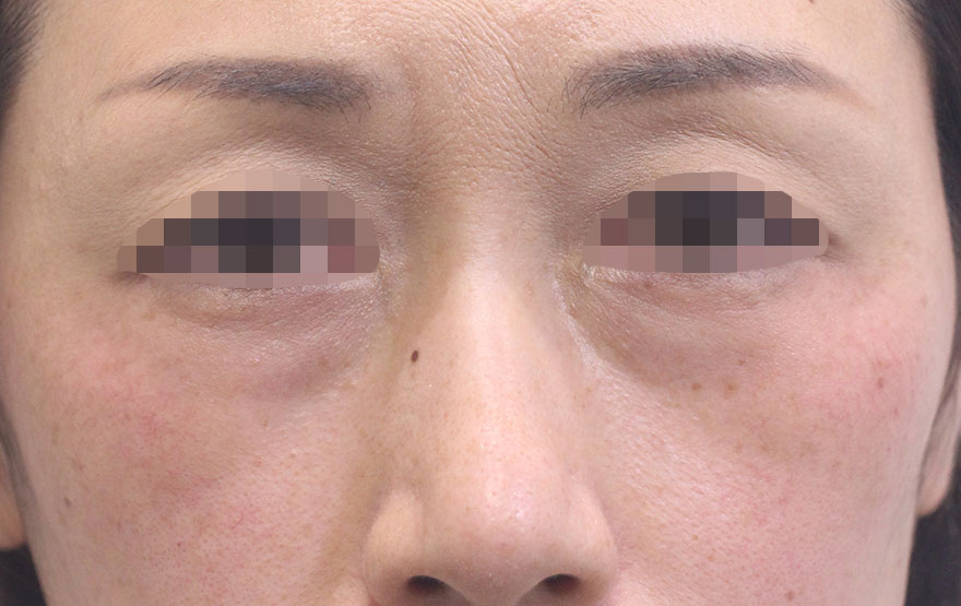 目の下のクマ,ゴルゴ線の症例写真（Before）／50代 女性