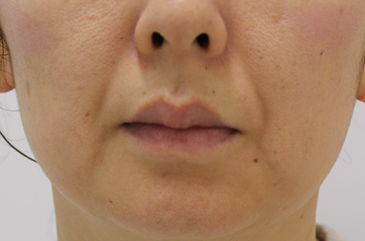 口の周りの症例写真（Before）／40代 女性