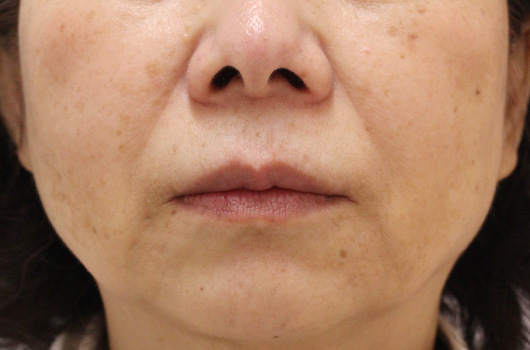 口の周りの症例写真（After）／60代 女性