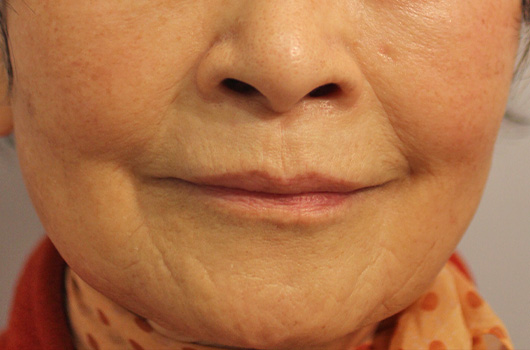 口の周り,ほうれい線の症例写真（After）／80代 女性