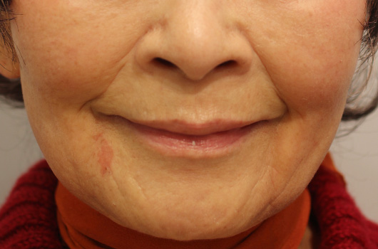 口の周り,ほうれい線の症例写真（Before）／80代 女性